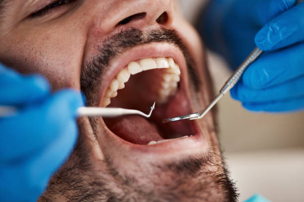 Best Urgent Care for Lost Fillings or Crowns in Richfield, MN