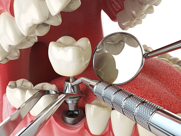 Best Emergency Tooth Extraction in Richfield, MN